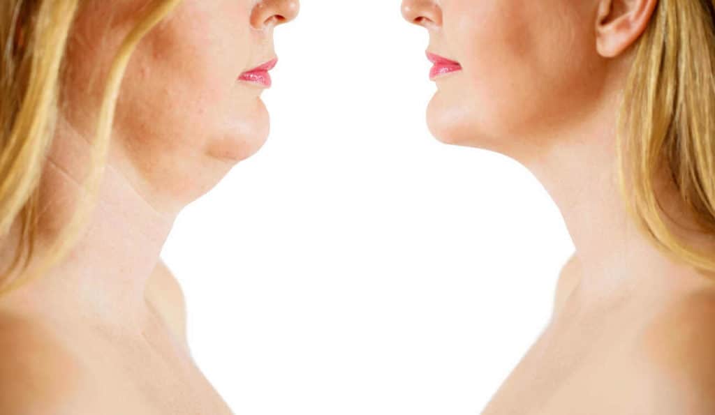 Double Chin treatment Abbots Langley before and after results