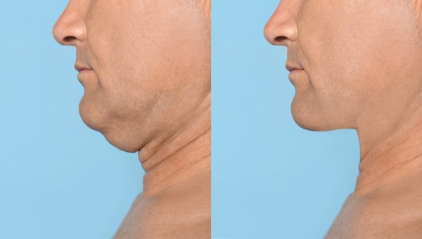 Which Non-Surgical Treatments Work Best for Jowls and Loose Skin Abbots Langley?