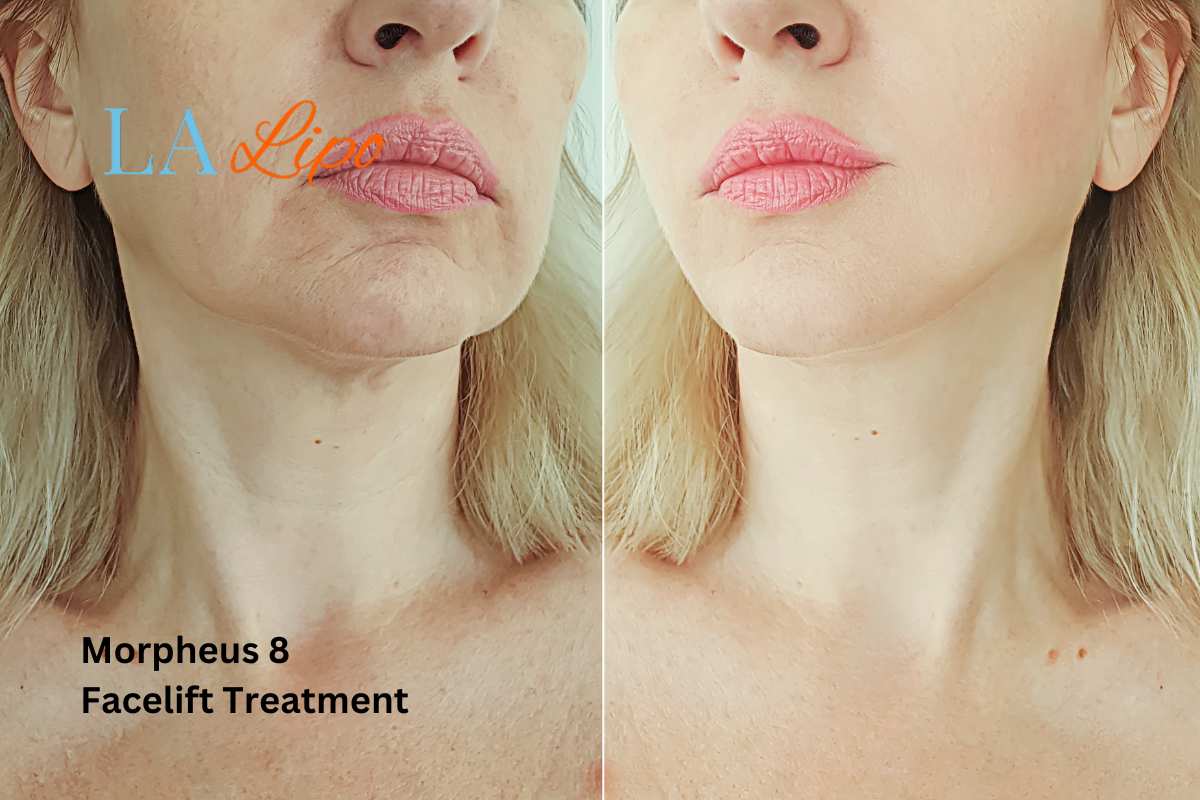 Turn back time with Morpheus8 Treatment Abbots Langley