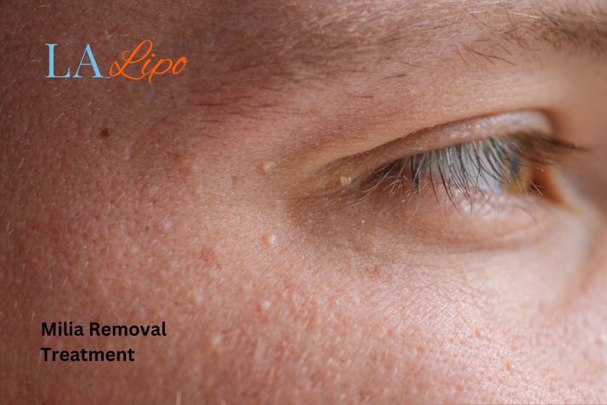 Cryopen Milia Removal: Is It the Easiest and Safest Option Abbots Langley?