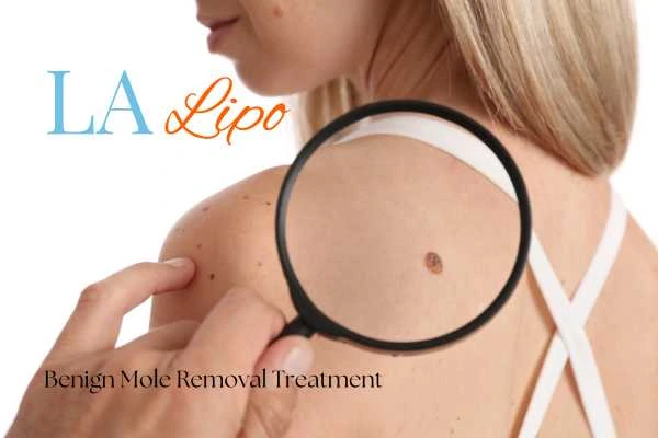 Why getting moles removed Abbots Langley can boost your confidence!