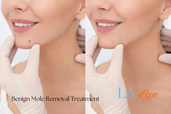 woman's before and after mole removal Abbots Langley results