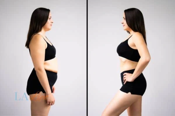 image of woman before and after results of LA-EMS Body Sculpting Abbots Langley to help treat Diastasis recti