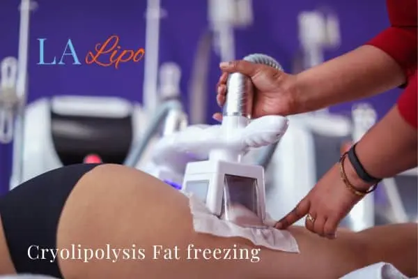 women getting fat freezing Abbots Langley