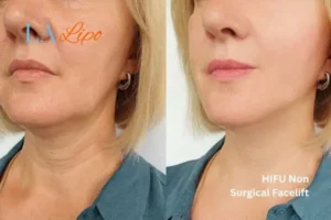 hi-fu for wrinkles Abbots Langley before and after results