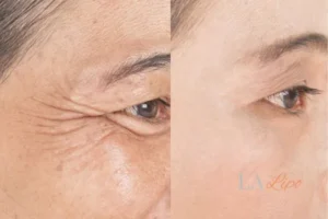 Before and after results of woman - HI-fu wrinkles reduction treatment Abbots Langley