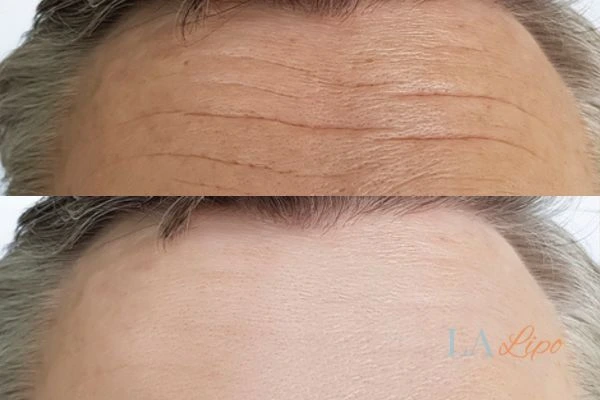results of HIFU Abbots Langley on mans forehead to help reduce lines and wrinkles