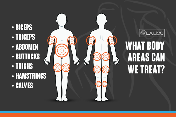 Graphic to show areas you can have LA-EMS Body Sculpting Abbots Langley treatment.