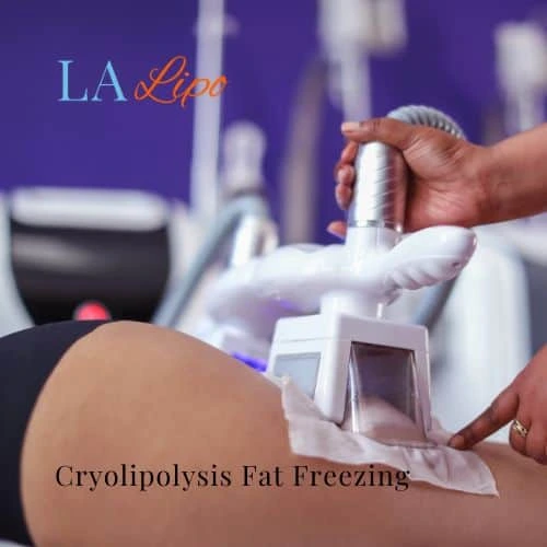 fat freezing - Cryolipolysis Abbots Langley