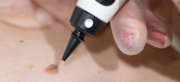 skin tag removal using cryopen Abbots Langley