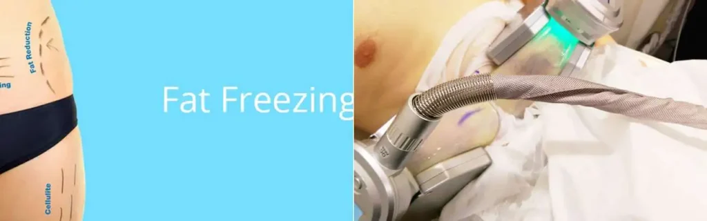 Fat freezing Abbots Langley on multiple areas of the body