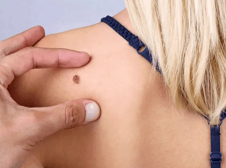 woman having mole removal Abbots Langley consultation before treatment.