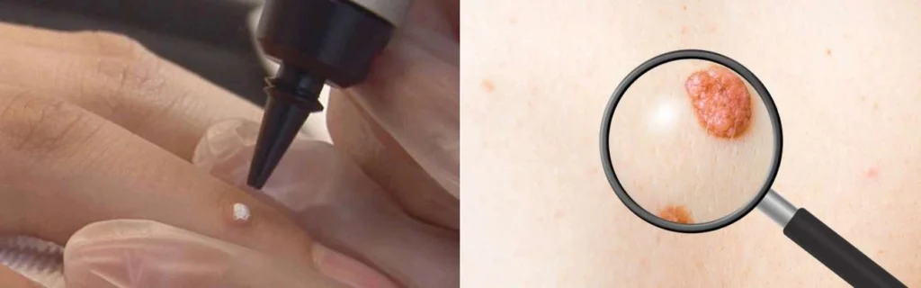 Person getting moles removed with cryopen Abbots Langley