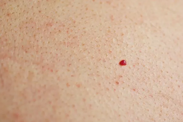 close up of a cherry angioma Abbots Langley