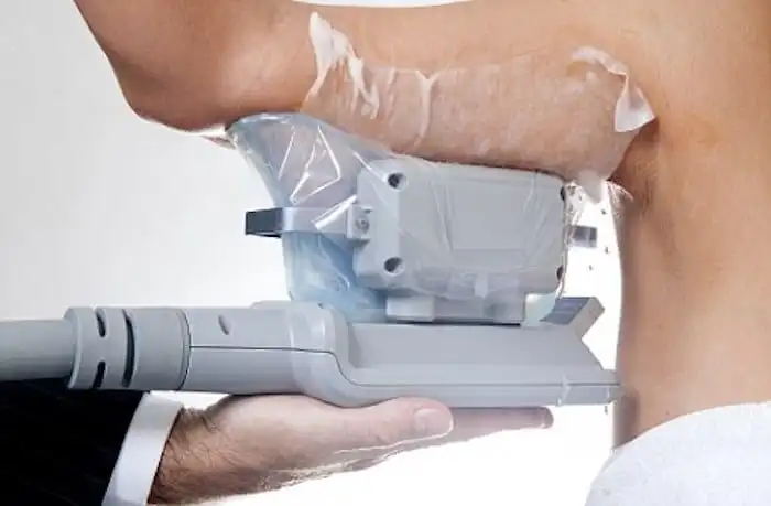 Picture of fat freezing Abbots Langley on the upper arms.