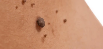 image of a skin tag Abbots Langley