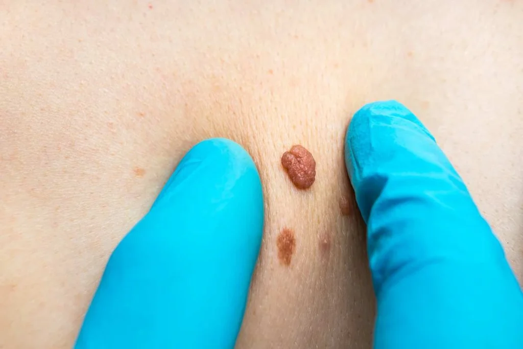 Consultant examining a skin tag Abbots Langley