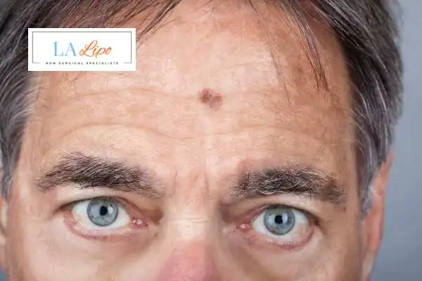 Solar Lentigo Removal Abbots Langley image of man with mark on his forehead