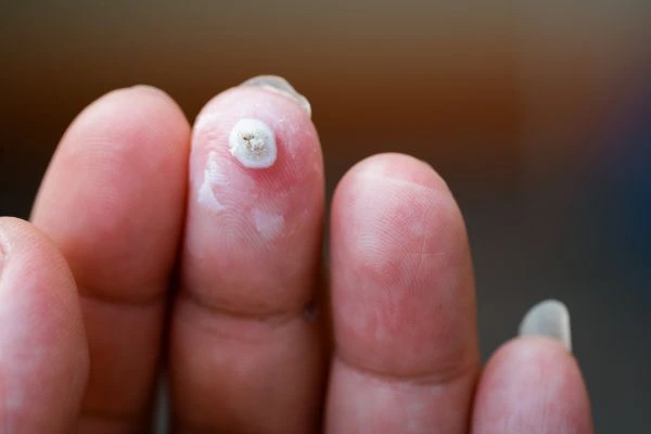 wart on person finger - cryotherapy to treat from LA LIPO Abbots Langley