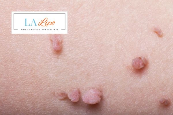 Does cryopen skin tag removal Abbots Langley hurt? Find out now call our team today!