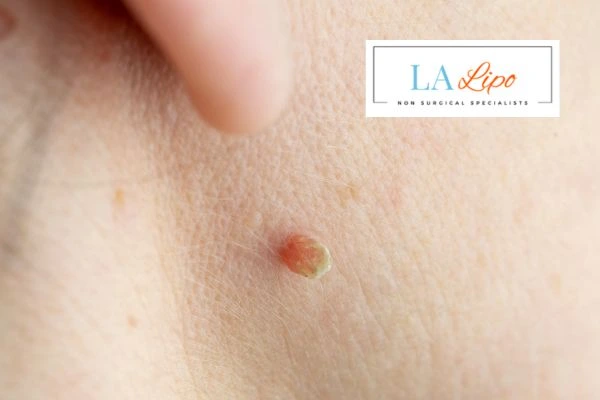 Book skin tag removal Abbots Langley today speak to our team now!