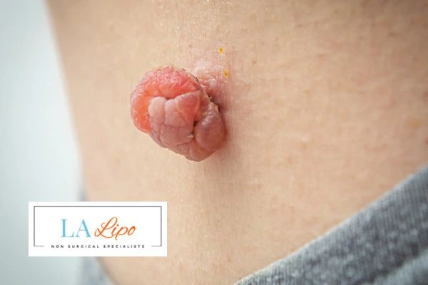 Interested in skin tag removal Abbots Langley? Concerned about the pain? Find out more today!