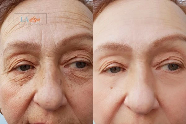 The powerful benefits of Morpheus8 Treatment Abbots Langley - Call Our team today!