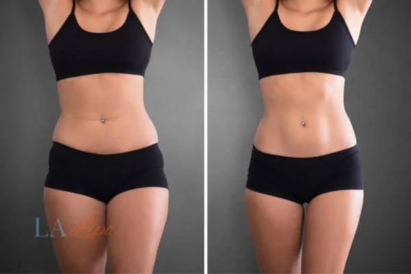 before and after results of non-surgical treatment to help a woman's body image and mental health Abbots Langley