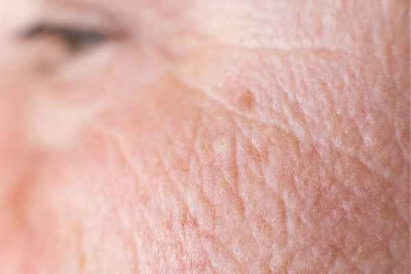 close up picture of a woman's face showing an age spot Abbots Langley