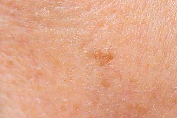 close up picture of age spots Abbots Langley
