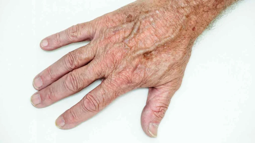 Male hand showing age spot Abbots Langley
