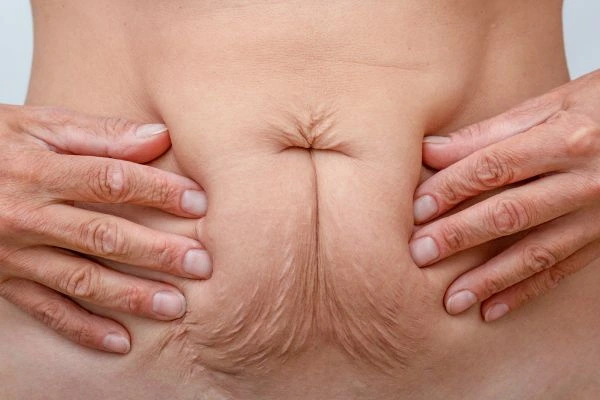 Image of a woman's stomach with loose skin - example of skin tightening Abbots Langley options