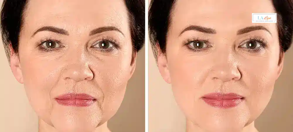 How Long Does It Take to See Results and How Long Do They Last Abbots Langley?